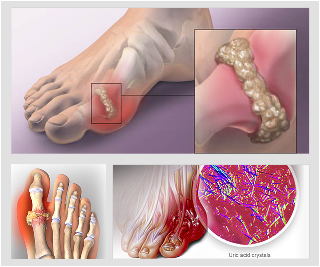 Hộ Phong Tán Thống - Thảo Dược Trị Bệnh Gout