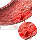 Bệnh Gout có thể gây sỏi thận, thận ứ nước ứ mủ, suy thận (như tiểu ra máu, sạn đường tiểu, suy thận cấp hay mãn tính), tăng huyết áp, tai biến mạch máu não, nhồi máu cơ tim
