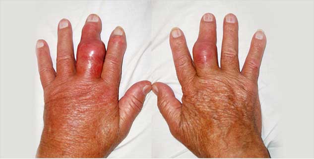 Hộ Phong Tán Thống - Thảo Dược Trị Bệnh Gout