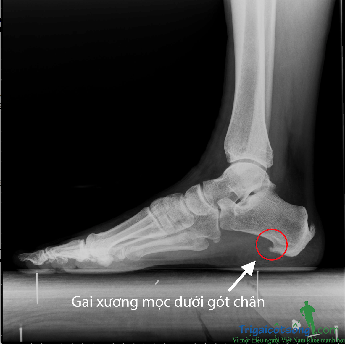 Ảnh chụp X-quang gai gót chân
