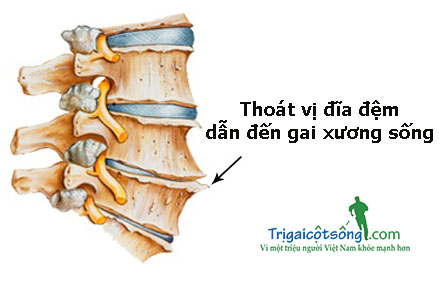 Đau xương sống vùng thắt lưng 3