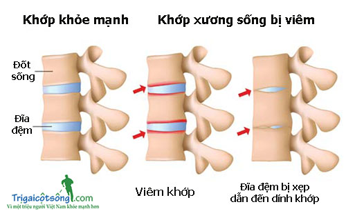 Đau xương sống vùng thắt lưng 1