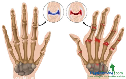 Cách điều trị thoái hóa khớp bàn tay ngón tay 1