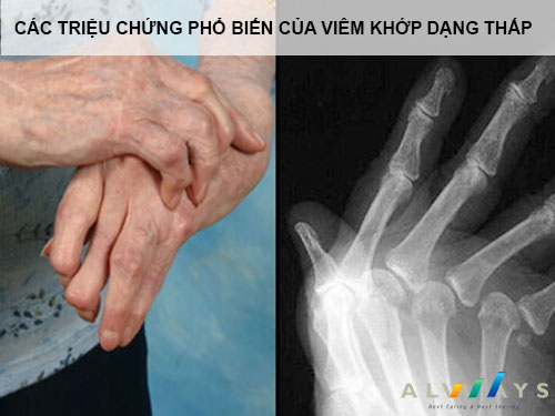 Triệu chứng viêm khớp dạng thấp ở bàn tay