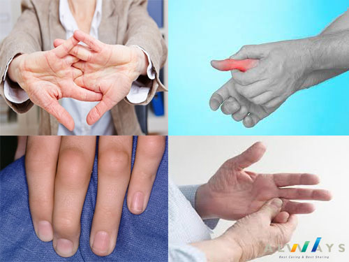Dấu hiệu sớm của bệnh viêm khớp ngón tay