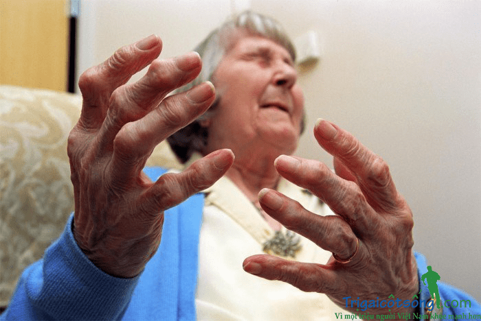 Hội chứng ống cổ tay có nguyên nhân do viêm khớp dạng thấp