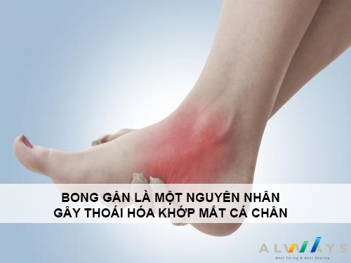 Bong gân có thể là nguyên nhân gây thoái hóa khớp mắt cá chân