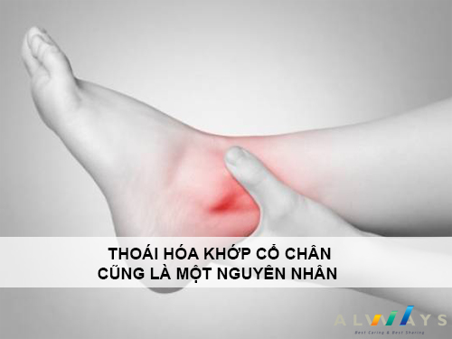 Thoái hóa khớp cổ chân là một trong những nguyên nhân