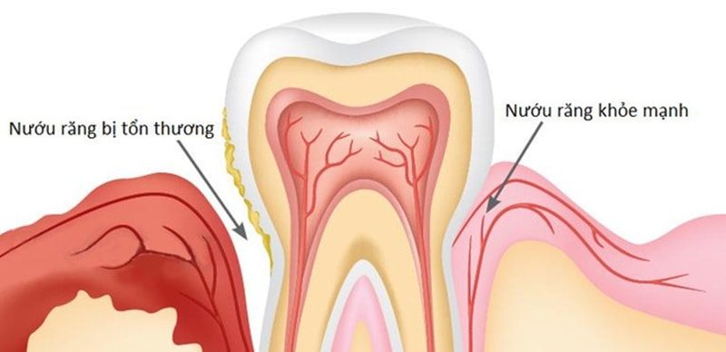 cách chữa đau răng 